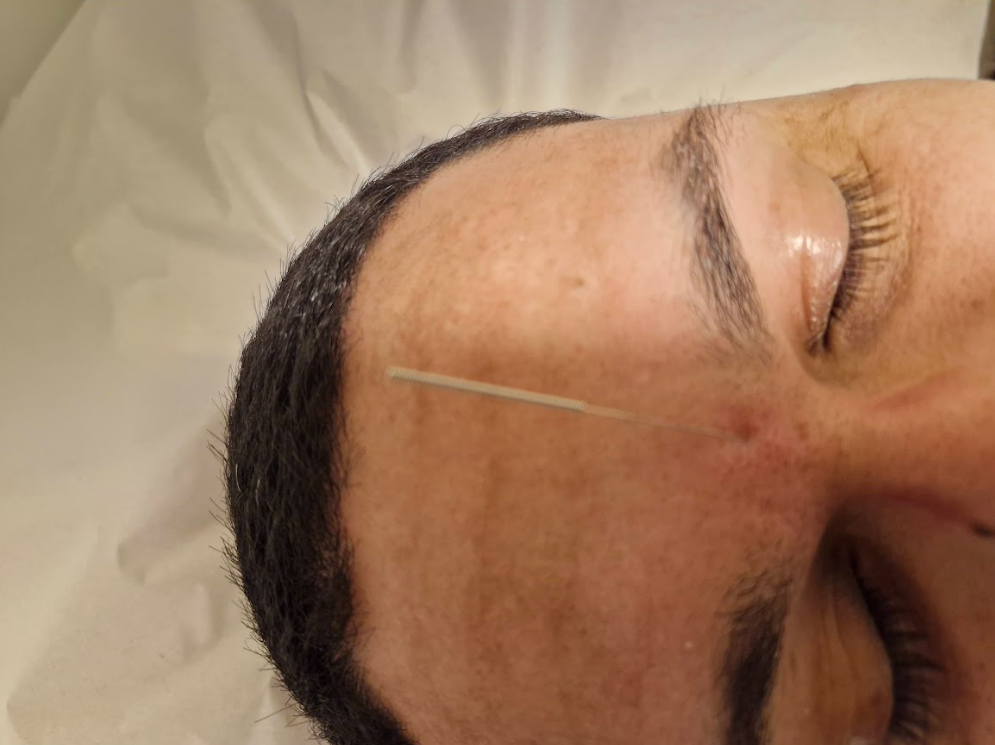 Aplicação de acupuntura no ponto entre as sobrancelhas, paciente relaxado no Yoga du Ville, Tijuca